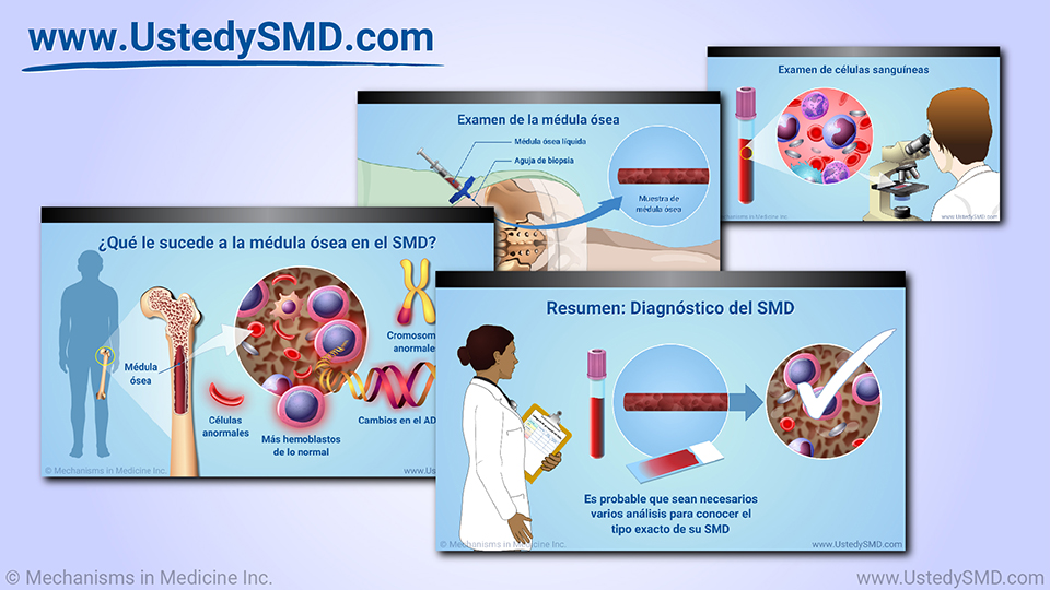 Diagnóstico de los síndromes mielodisplásicos (SMD)”