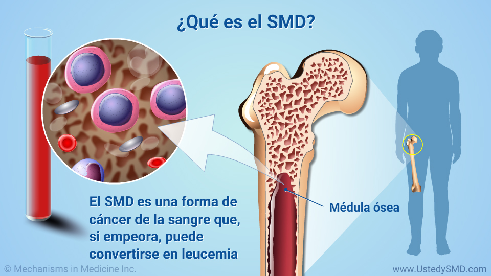 ¿Qué es el SMD?