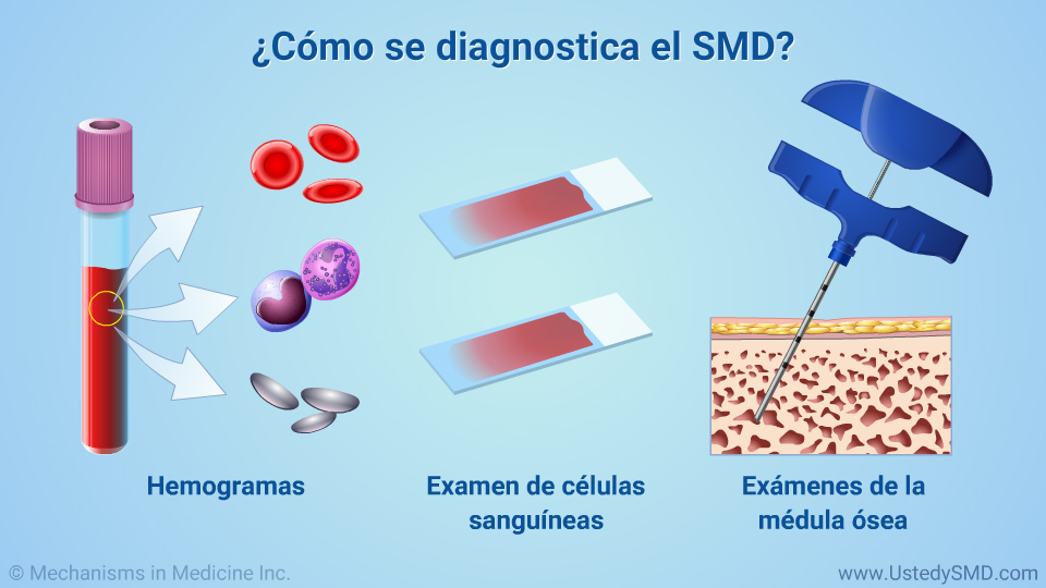 ¿Cómo se diagnostica el SMD?
