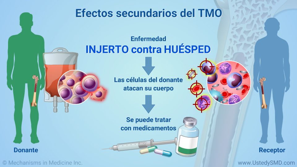 Efectos secundarios del TMO