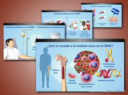 Acceda a presentaciones de diapositivas visualmente informativas sobre los síndromes mielodisplásicos.